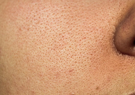 Enlarged Pores — Mistakes to Avoid 