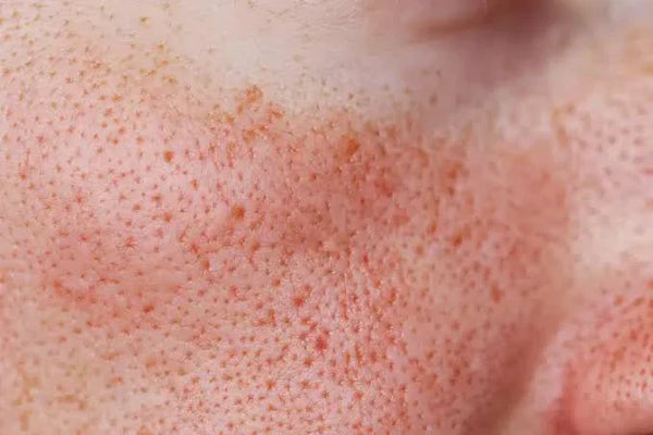 Enlarged Pores, Explained: Why You Have Them and How to Soften the Look