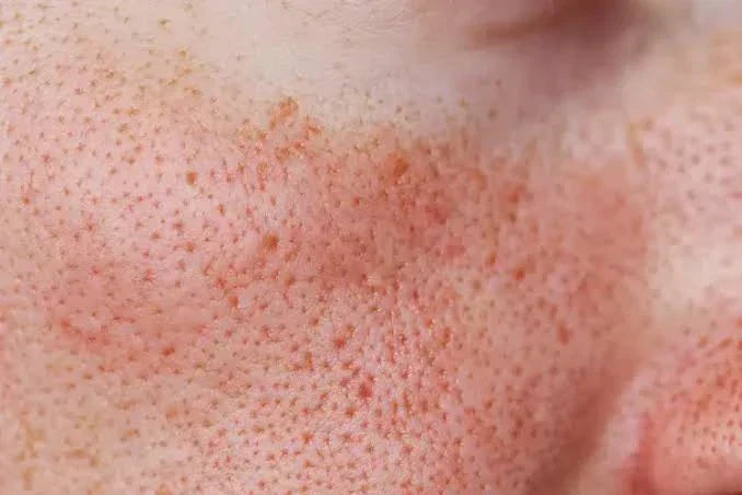 Enlarged Pores, Explained: Why You Have Them and How to Soften the Look 