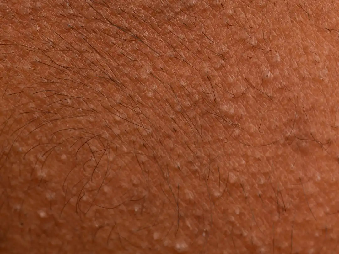 Erythromelanosis follicularis faciei et colli showing facial redness, hyperpigmentation and follicular papules
