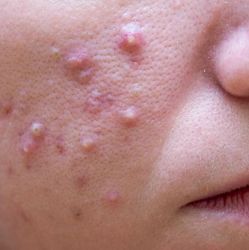 "Close-up of facial acne showing inflamed pimples, whiteheads, acne bumps, and post-acne marks."