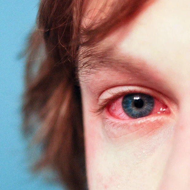 What Irritates the Eye Area: Common Cosmetic Culprits and How They Get There
