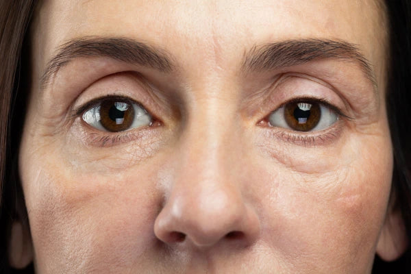 Why Do I Have Under-Eye Bags? What Causes Puffiness, Explained 