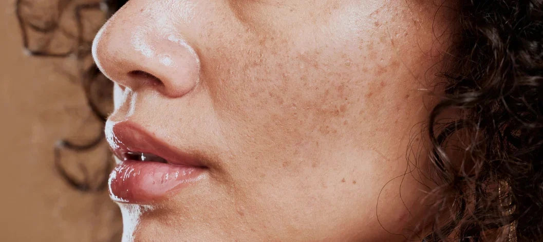 Facial hyperpigmentation and uneven skin tone associated with friction and skin irritation