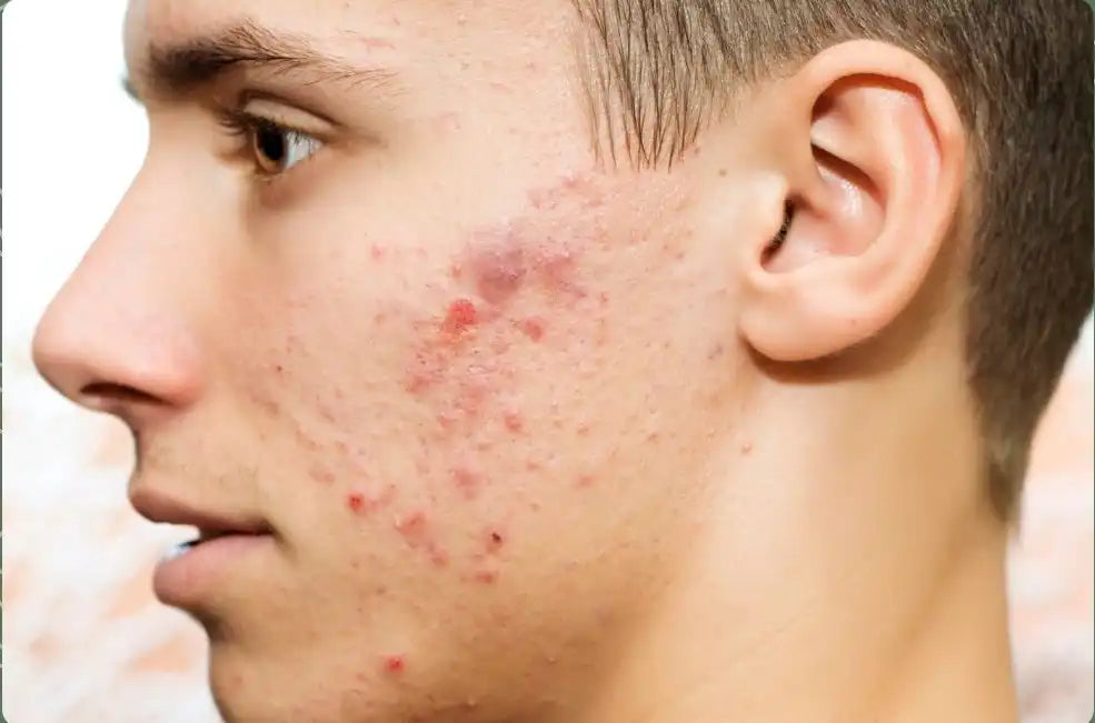 Fungal acne vs bacterial acne showing Malassezia folliculitis and acne vulgaris differences