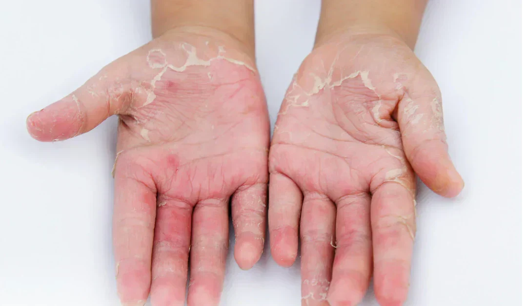 Hand Eczema: Types, Appearance & Skincare Management – ingredient hero