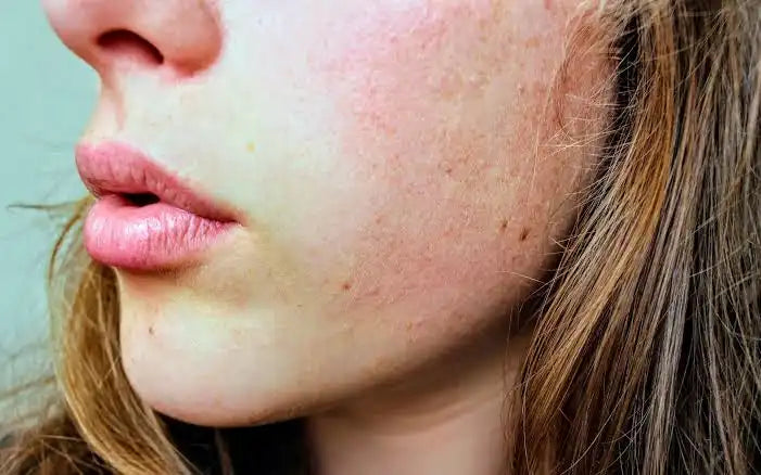 Sensitive skin exposed to hard-water cleansing and potential barrier stress