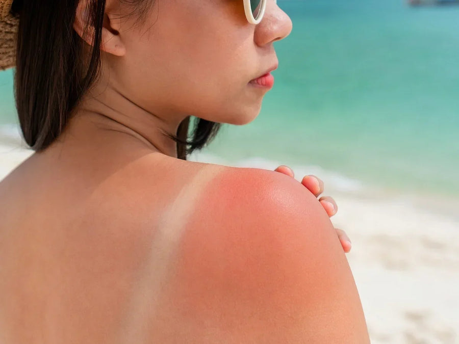 How to Get Rid of Heat Rash: What Actually Helps