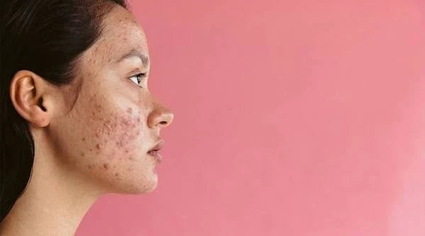 Hormonal Acne & Diet — What Role Does Food Play?
