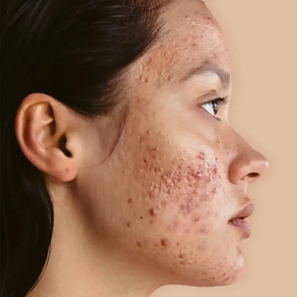 Woman with visible acne breakouts associated with hormonal skin changes and oil production