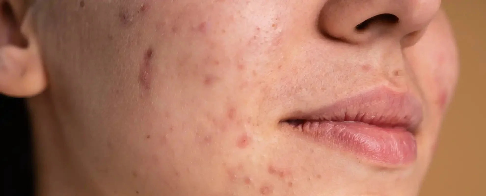 How Hormones Affect Your Skin — Complete Guide - Boldpurity Skincare