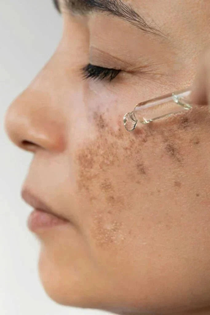 HYPERPIGMENTATION ON INDIAN & DARK SKIN: SCIENCE & SOLUTIONS
