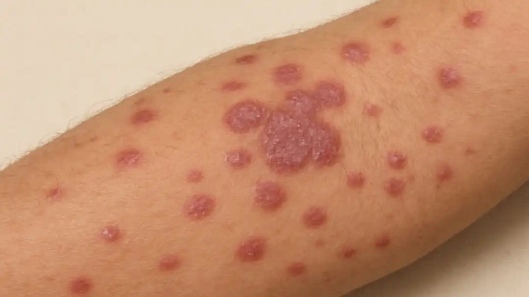 Lichen planus skin lesions showing darkened pigmentation and inflammatory changes on the forearm 