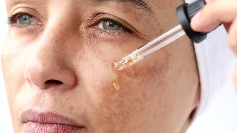 Melasma on the Face in Indian Skin: What Is Melasma, Its Causes, What Research Says About Treatment