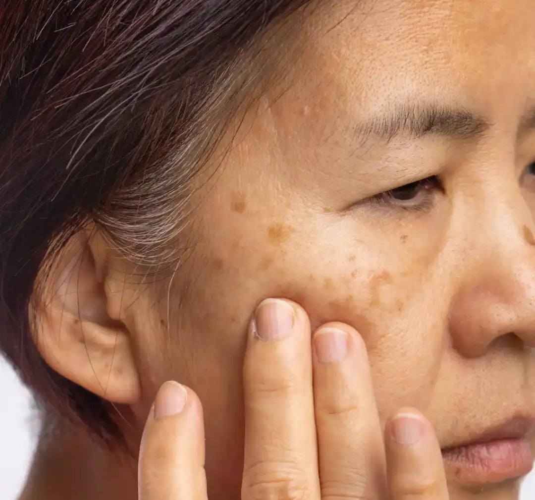 Menopause skin changes affecting hydration collagen and pigmentation