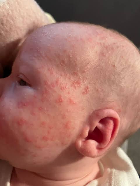 Milia, Explained: What Those Little White Bumps Are (and Aren't)