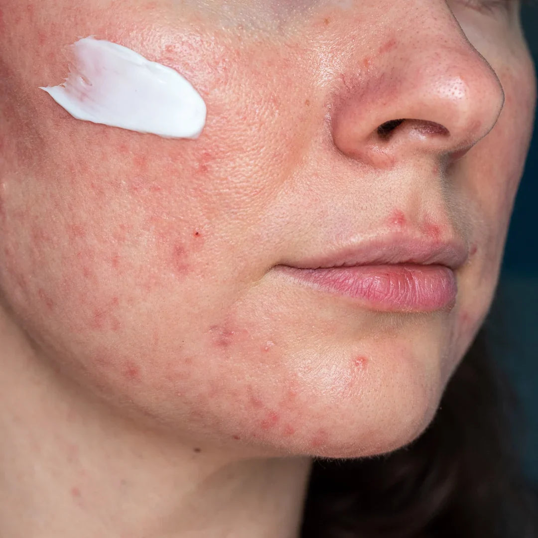 Niacinamide calming inflammation in an acne breakout"