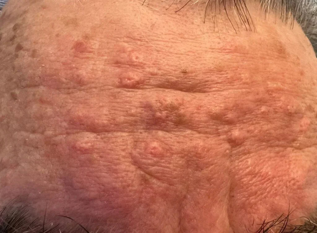 Common Benign Skin Nodules: Types, Appearance & When to See a Professional