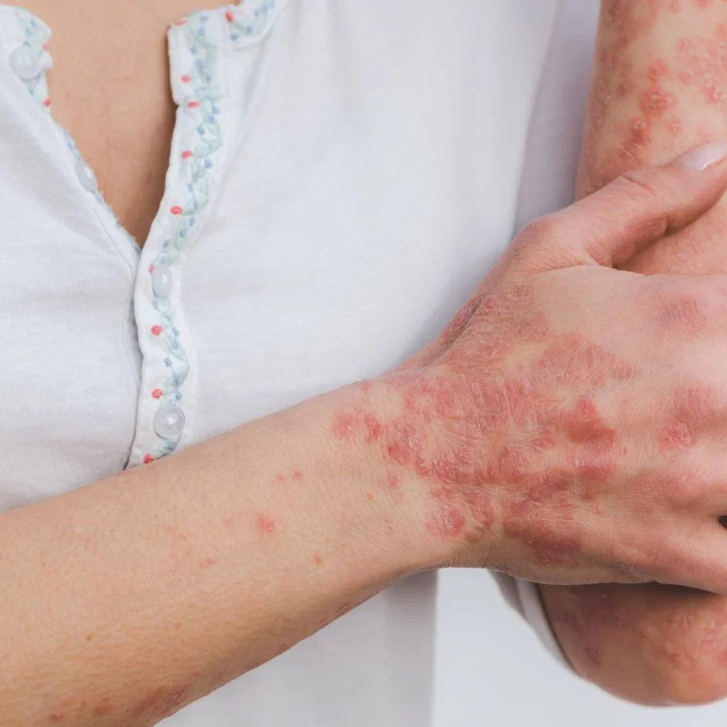  "Comparison of the BSA, PASI and DLQI psoriasis severity scores"