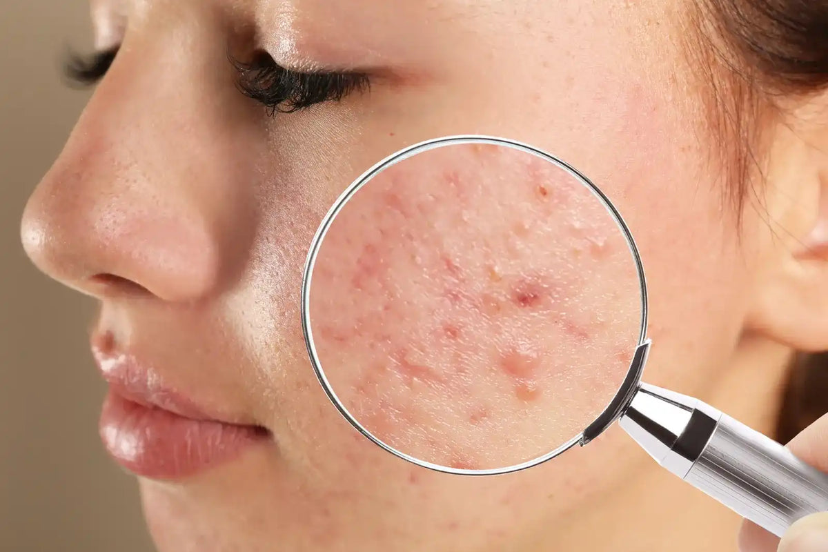 PCOS and Skin: Acne, Oiliness, Hair Changes & Acanthosis Nigricans | Boldpurity