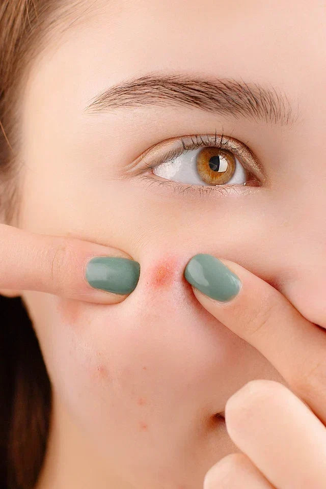 Should You Pop Pimples? Scarring, Hyperpigmentation & Appearance Risks