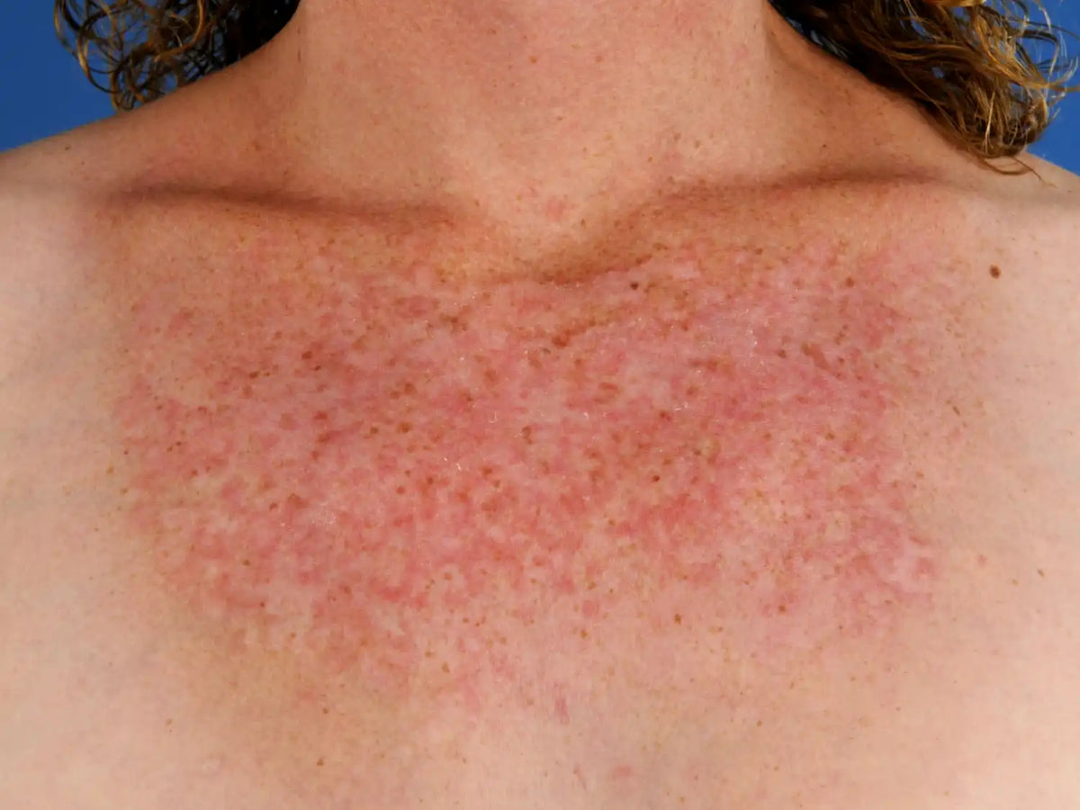 Poikiloderma of Civatte: Pigmentation, Redness & Neck Photoaging | Boldpurity – ingredient hero