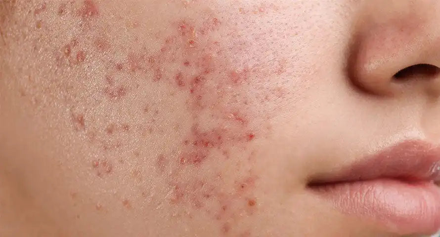 How air pollution and PM2.5 may affect skin through oxidative stress and environmental exposure