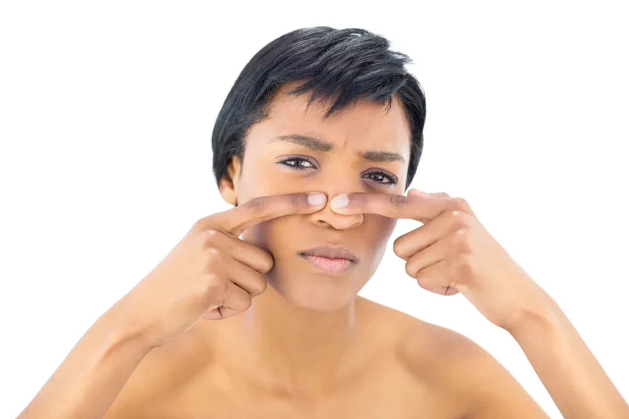 Why You Shouldn't Pop Your Blackheads (and What to Do Instead)