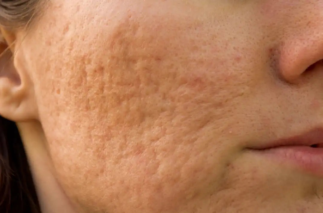 Why pores look bigger showing pore anatomy, sebum, skin texture and aging factors