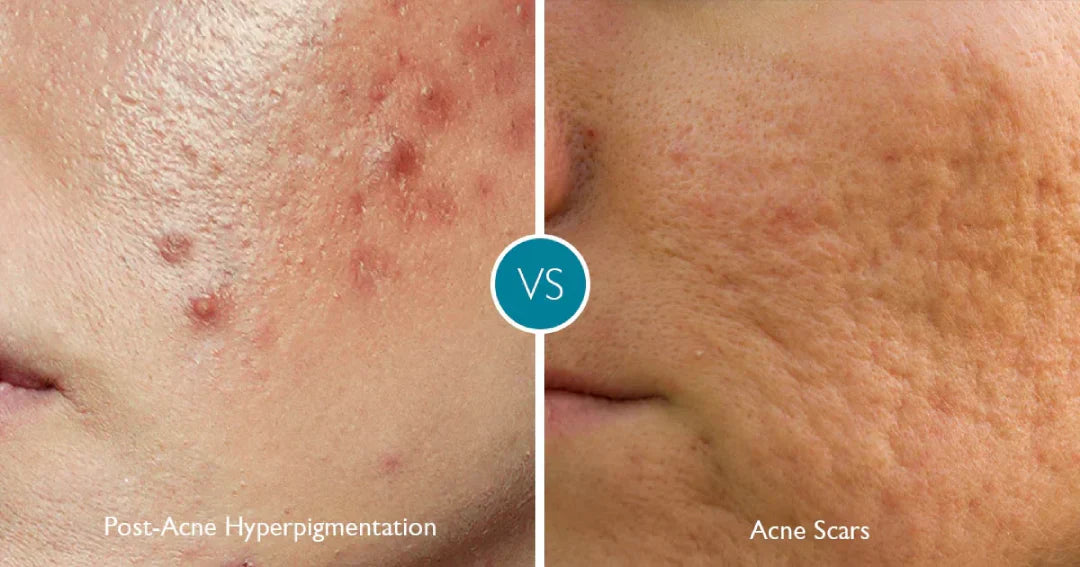 Should You Pop Pimples? Scarring, Hyperpigmentation & Appearance Risks – ingredient hero