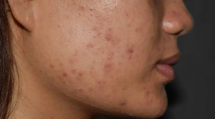 Post-Inflammatory Hyperpigmentation (PIH): Causes, Mechanism & What Actually Works | Boldpurity - Boldpurity Skincare