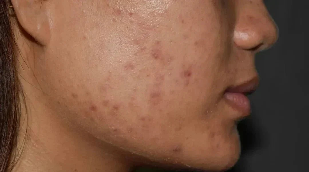 Post-Inflammatory Hyperpigmentation (PIH): Causes, Mechanism & What Actually Works | Boldpurity - Boldpurity Skincare