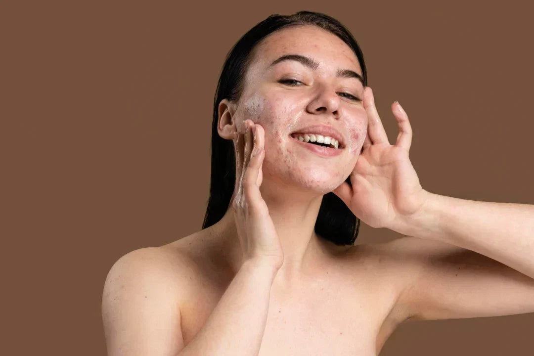 "Pregnancy hormones increase oil production, which can trigger acne"