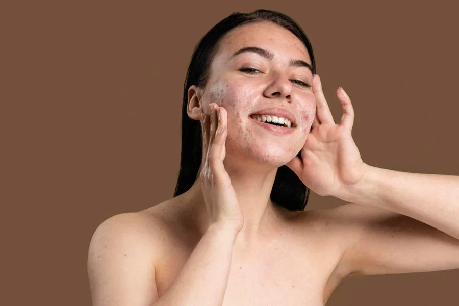 Acne During Pregnancy: What's Safe and What to Avoid