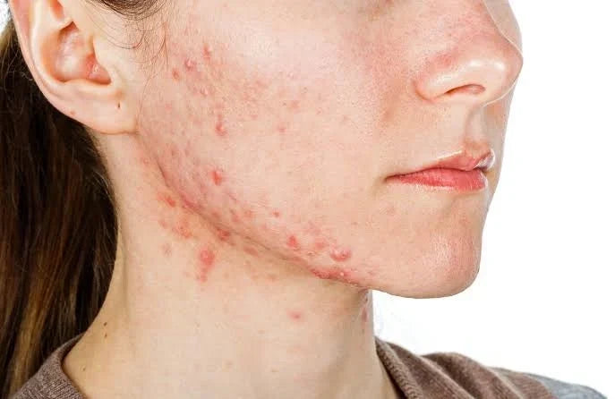 The skin microbiome and Cutibacterium acnes strains involved in acne