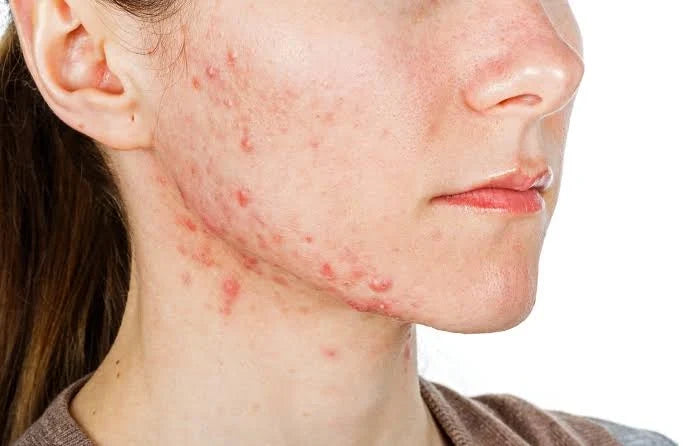 The skin microbiome and Cutibacterium acnes strains involved in acne