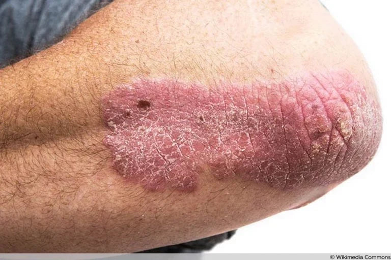 "Calm stress-management practices that support psoriasis care"