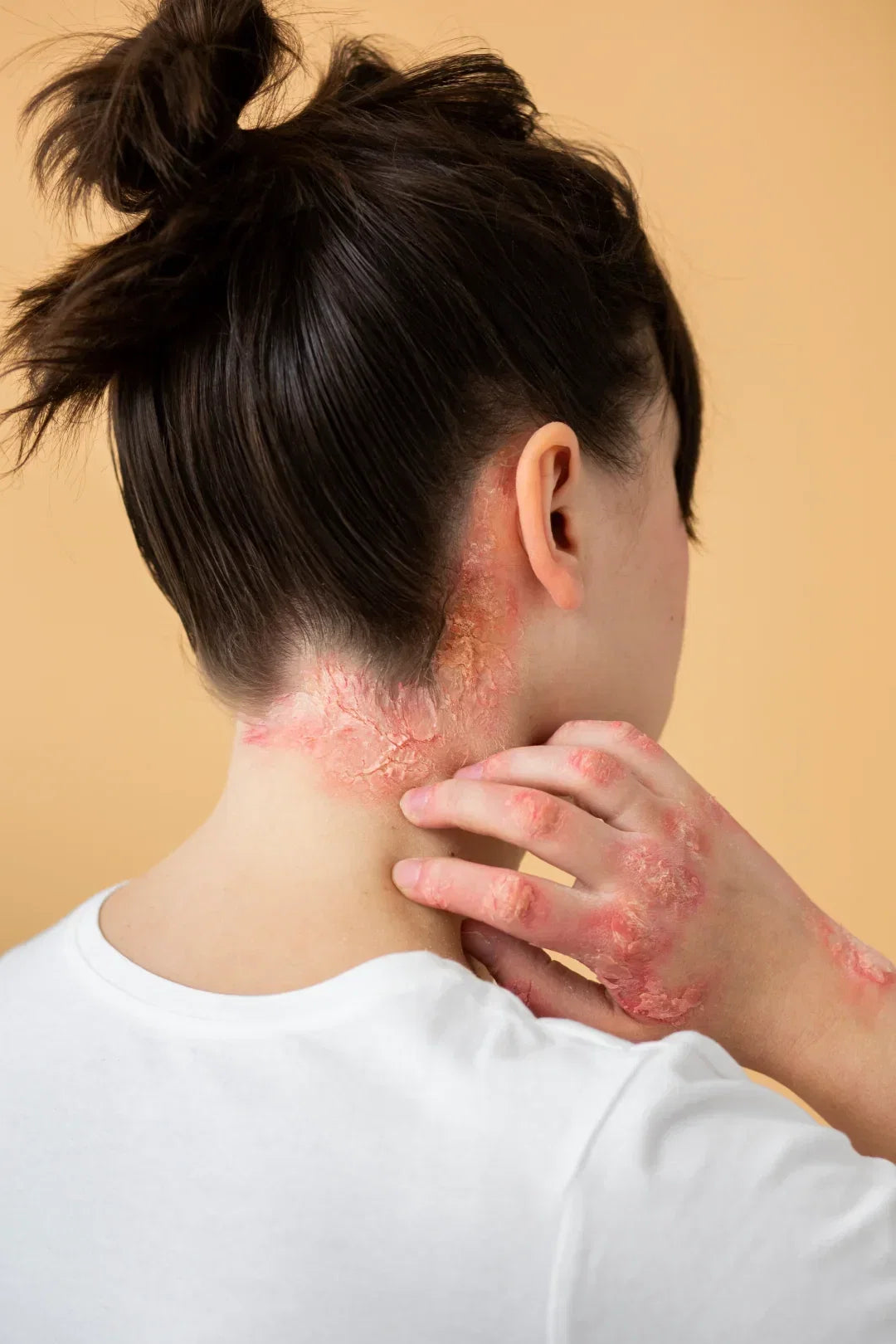 Psoriasis plaque with silvery scale on an elbow (extensor surface)"