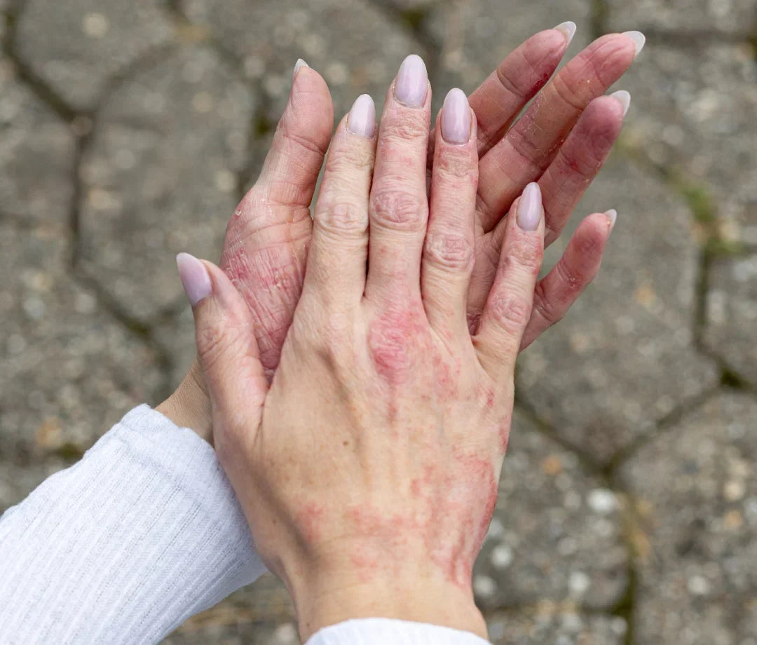 Psoriasis on hands and vitamins that may support skin health