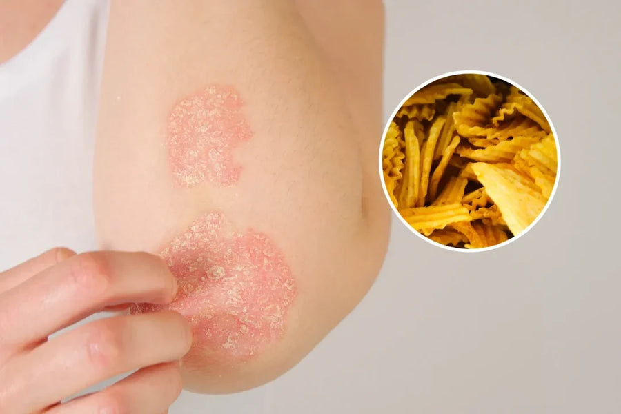 Elbow affected by psoriasis with processed snack foods illustrating the possible dietary link to psoriasis