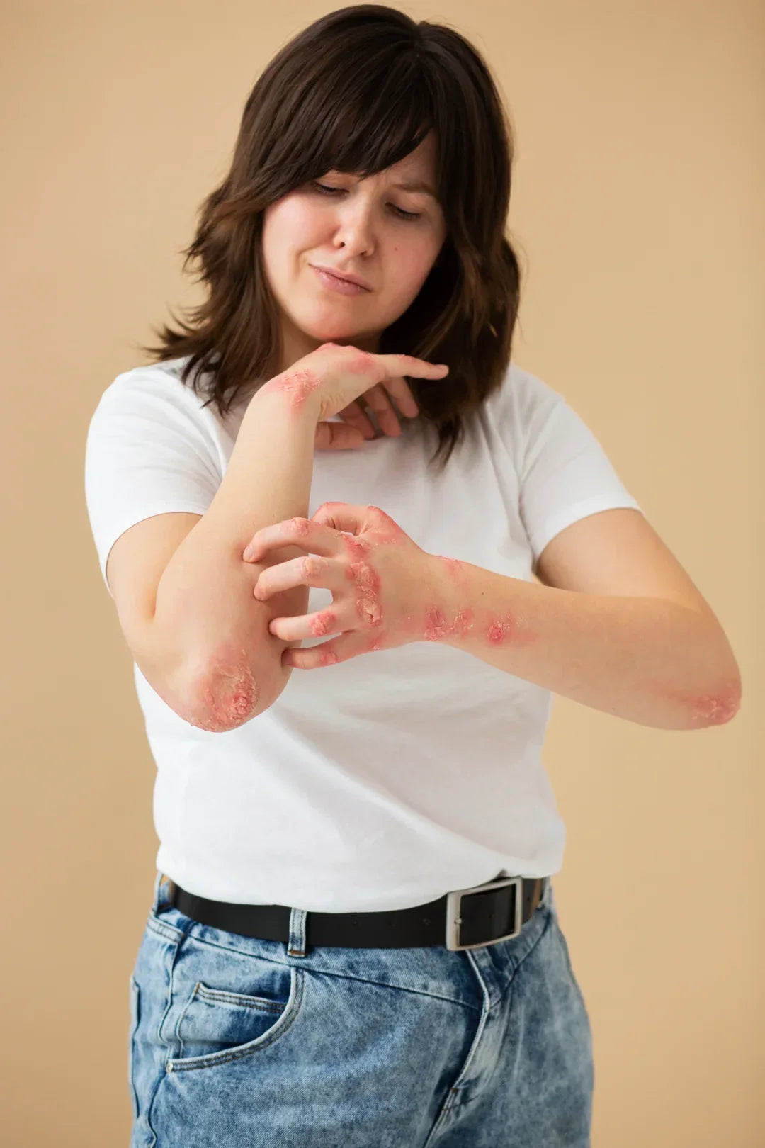 Psoriasis is multifactorial — genetic predisposition combined with triggers"