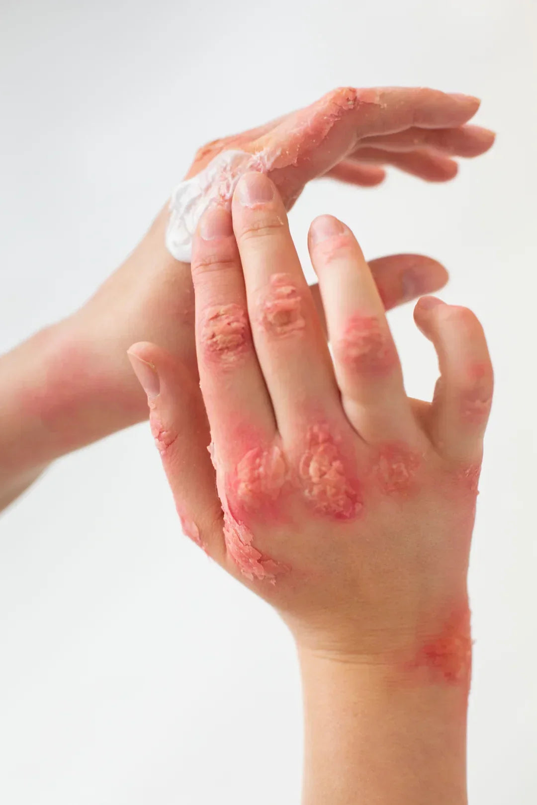 Moisturising psoriasis-prone skin after a lukewarm soak to soften scale"