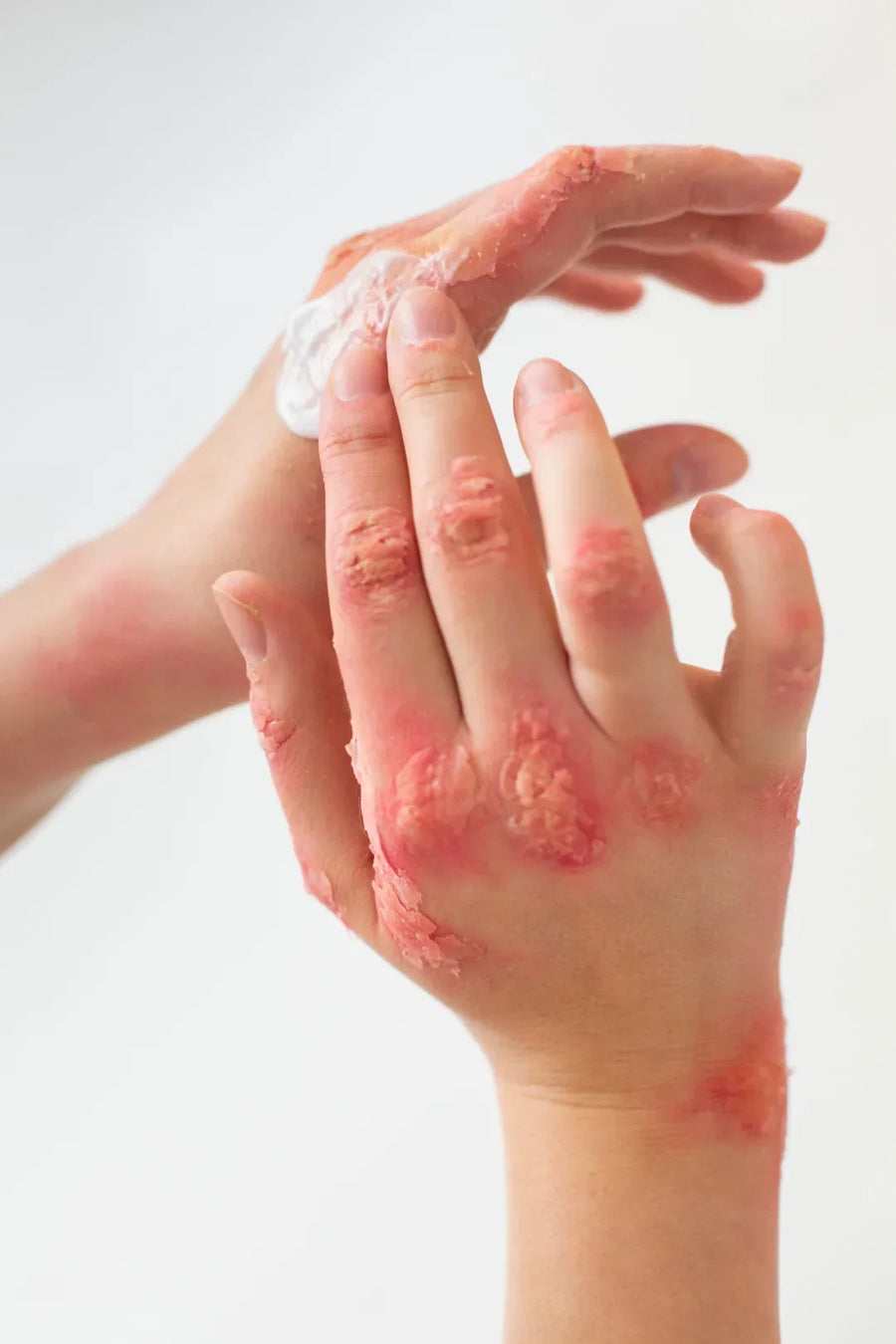 Psoriasis: How to Exfoliate Your Skin Safely