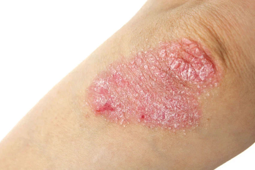 "Common psoriasis flare triggers: infection, stress, skin injury, alcohol, smoking"
