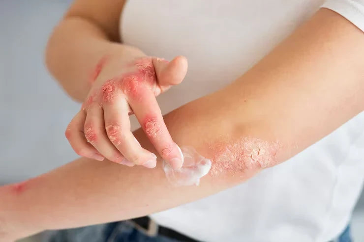 "Applying a rich balm to slightly damp skin to lock in moisture for psoriasis"