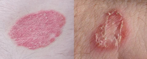 Side-by-side comparison of psoriasis plaques and a ringworm ring rash"