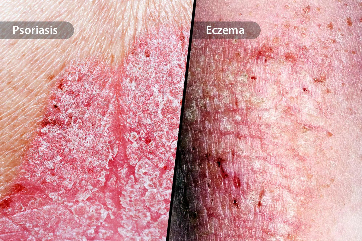 Eczema vs psoriasis showing differences in skin appearance