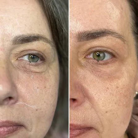 Does Draining the Under-Eyes Really Reduce Puffiness & Dark Circles? – ingredient hero