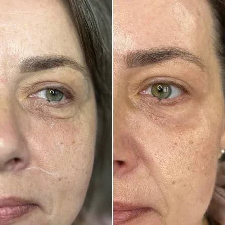 Does Draining the Under-Eyes Really Reduce Puffiness & Dark Circles? 
