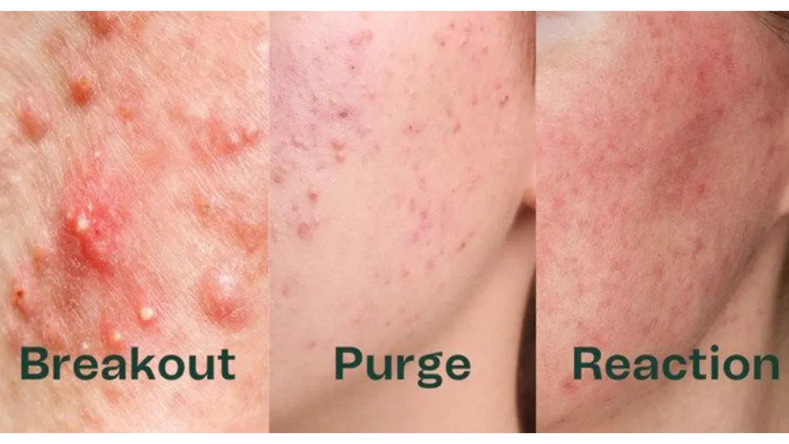 "Comparison of purging, acne breakout and allergic reaction signs"